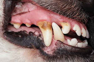 Stade 2 : Maladie parodontale précoce