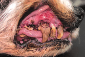 Stade 4 : Maladie parodontale avancée